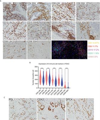 Large-Section Histopathology Can Better Indicate the Immune Microenvironment and Predict the Prognosis of Pancreatic Ductal Adenocarcinoma Than Small-Section Histopathology